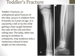 Toddler’s Fracture
Toddler’s fracture, an
undisplaced spiral fracture of
the tibia, occurs in children from
9 months to 3 years of age. It is
caused by a fall or by the child
getting a foot caught between
the slats of the crib and then
rolling over. The baby, often too
young to verbalize its
complaints, may evidence only a
mysterious refusal to bear
weight on the extremity.
 