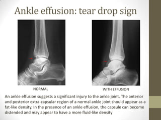 Ankle effusion: tear drop sign




                NORMAL                                 WITH EFFUSION
An ankle effusion suggests a significant injury to the ankle joint. The anterior
and posterior extra-capsular region of a normal ankle joint should appear as a
fat-like density. In the presence of an ankle effusion, the capsule can become
distended and may appear to have a more fluid-like density
 