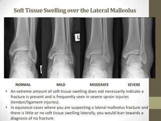 Soft Tissue Swelling over the Lateral Malleolus




     NORMAL                 MILD               MODERATE             SEVERE
• An extreme amount of soft tissue swelling does not necessarily indicate a
  fracture is present and is frequently seen in severe sprain injuries
  (tendon/ligament injuries).
• In equivocal cases where you are suspecting a lateral malleolus fracture and
  there is little or no soft tissue swelling laterally, you would lean towards a
  diagnosis of no fracture.
 