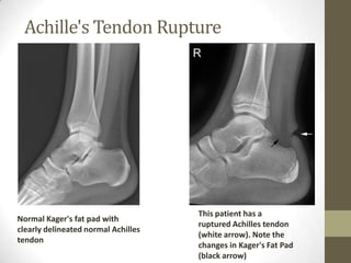 Achille's Tendon Rupture




                                     This patient has a
Normal Kager's fat pad with
                                     ruptured Achilles tendon
clearly delineated normal Achilles
                                     (white arrow). Note the
tendon
                                     changes in Kager's Fat Pad
                                     (black arrow)
 
