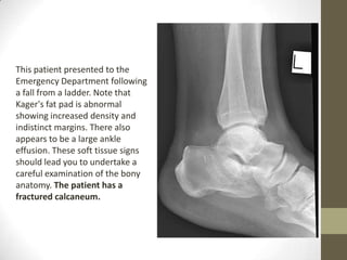 This patient presented to the
Emergency Department following
a fall from a ladder. Note that
Kager's fat pad is abnormal
showing increased density and
indistinct margins. There also
appears to be a large ankle
effusion. These soft tissue signs
should lead you to undertake a
careful examination of the bony
anatomy. The patient has a
fractured calcaneum.
 
