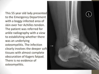 This 55 year old lady presented
to the Emergency Department
with a boggy infected area of
skin over her Achilles tendon.
The patient was referred for
ankle radiography with a view
to establishing whether there
was an underlying
osteomyelitis. The infection
clearly involves the deeper soft
tissues with almost complete
obscuration of Kagers fatpad.
There is no evidence of
osteomyelitis.
 
