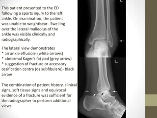 This patient presented to the ED
following a sports injury to the left
ankle. On examination, the patient
was unable to weightbear . Swelling
over the lateral malleolus of the
ankle was visible clinically and
radiographically.
The lateral view demonstrates
* an ankle effusion- (white arrows)
* abnormal Kager's fat pad (grey arrow)
* suggestion of fracture or accessory
ossification centre (os subfibulare)- black
arrow

The combination of patient history, clinical
signs, soft tissue signs and equivocal
evidence of a fracture was sufficient for
the radiographer to perform additional
views
 