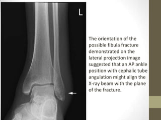 The orientation of the
possible fibula fracture
demonstrated on the
lateral projection image
suggested that an AP ankle
position with cephalic tube
angulation might align the
X-ray beam with the plane
of the fracture.
 