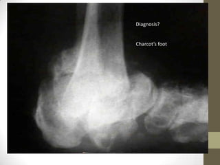 Diagnosis?


Charcot’s foot
 