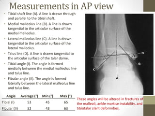 Measurements in AP view
 • Tibial shaft line (A). A line is drawn through
   and parallel to the tibial shaft.
 • Medial malleolus line (B). A line is drawn
   tangential to the articular surface of the
   medial malleolus.
 • Lateral malleolus line (C). A line is drawn
   tangential to the articular surface of the
   lateral malleolus.
 • Talus line (D). A line is drawn tangential to
   the articular surface of the talar dome.
 • Tibial angle (I). The angle is formed
   medially between the medial malleolus line
   and talus line.
 • Fibular angle (II). The angle is formed
   laterally between the lateral malleolus line
   and talus line.

   Angle       Average (°)   Min (°)   Max (°)
                                                    These angles will be altered in fractures of
Tibial (I)         53          45        65         the malleoli, ankle mortise instability, and
Fibular (II)       52          43        63         tibiotalar slant deformities.
 