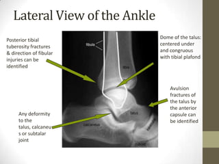 Measurements in Lateral view
Boehler’s Angle:
• The three highest points on the
  superior surface of the
  calcaneus are ...