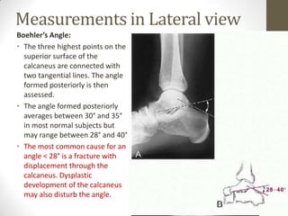 Radiographic Stress Tests of the Ankle

• Anterior Drawer
  Test
 • The anterior
   drawer test
   evaluates ATFL
   integ...
