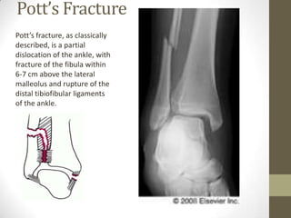 Dupuytren’s fracture
                • Mechanism similar
                  to Maisonneuve
                  fracture.
    ...