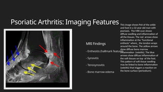 Enthesis On Radiograph ANKLE PPT FINAL radiologist perspective .pptx