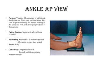 Comprehensive Guide to Ankle Radiography and Fracture Identification | PPTX