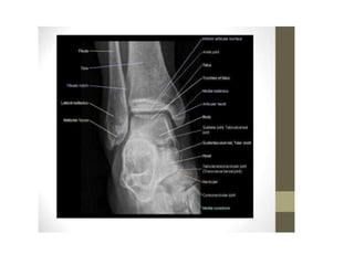 Angulo Tobillo Ankle radiological anatomy | PPTX