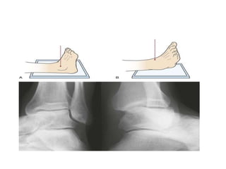 Ankle radiological anatomy | PPTX