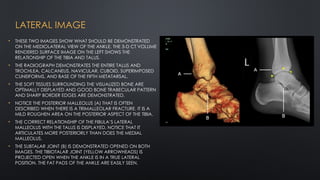 Radiological Features for Evaluation of the Ankle | PPTX