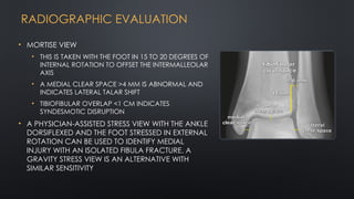 Radiological Features for Evaluation of the Ankle | PPTX