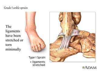 Grade I ankle sprain
The
ligaments
have been
stretched or
torn
minimally
 