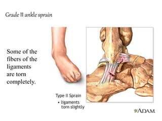 Grade II ankle sprain
Some of the
fibers of the
ligaments
are torn
completely.
 