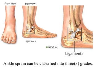Ankle sprain can be classified into three(3) grades.
 