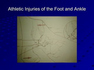 Athletic Injuries of the Foot and AnkleAthletic Injuries of the Foot and Ankle
 