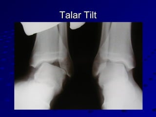 Talar TiltTalar Tilt
 