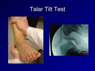 Talar Tilt TestTalar Tilt Test
 
