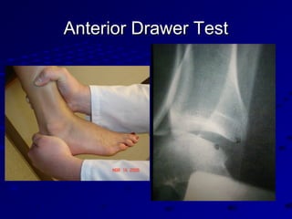 Anterior Drawer TestAnterior Drawer Test
 