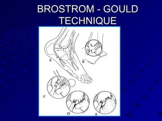 BROSTROM - GOULDBROSTROM - GOULD
TECHNIQUETECHNIQUE
 