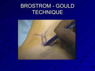 BROSTROM - GOULDBROSTROM - GOULD
TECHNIQUETECHNIQUE
 