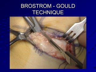 BROSTROM - GOULDBROSTROM - GOULD
TECHNIQUETECHNIQUE
 