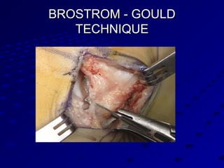 BROSTROM - GOULDBROSTROM - GOULD
TECHNIQUETECHNIQUE
 