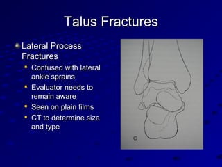 Talus FracturesTalus Fractures
Lateral ProcessLateral Process
FracturesFractures

Confused with lateralConfused with lateral
ankle sprainsankle sprains

Evaluator needs toEvaluator needs to
remain awareremain aware

Seen on plain filmsSeen on plain films

CT to determine sizeCT to determine size
and typeand type
 