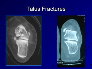 Talus FracturesTalus Fractures
 