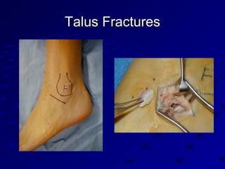 Talus FracturesTalus Fractures
 
