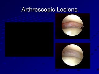Arthroscopic LesionsArthroscopic Lesions
 