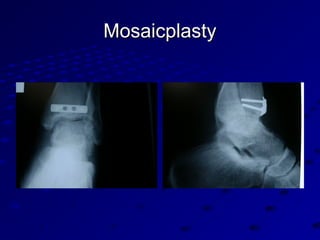 MosaicplastyMosaicplasty
 