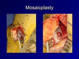 MosaicplastyMosaicplasty
 