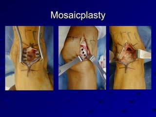 MosaicplastyMosaicplasty
 
