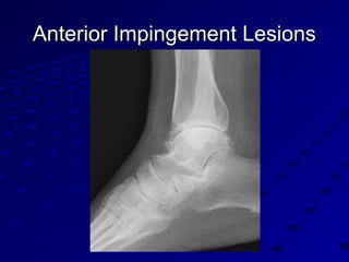 Anterior Impingement LesionsAnterior Impingement Lesions
 