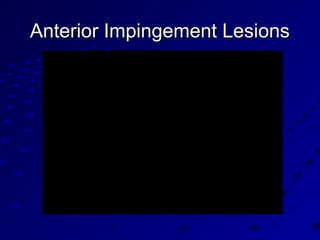 Anterior Impingement LesionsAnterior Impingement Lesions
 