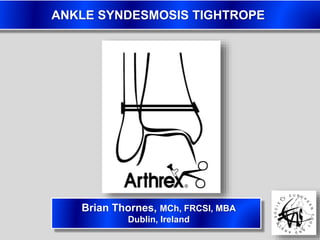 ANKLE SYNDESMOSIS TIGHTROPE
Brian Thornes, MCh, FRCSI, MBA
Dublin, Ireland
 