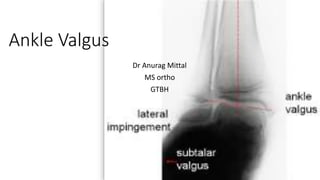 Ankle Valgus
Dr Anurag Mittal
MS ortho
GTBH
 