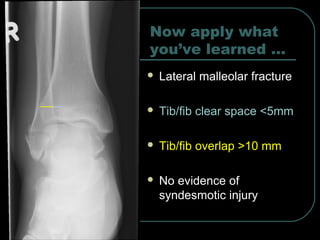 Now apply what 
you’ve learned … 
 Lateral malleolar fracture 
 Tib/fib clear space <5mm 
 Tib/fib overlap >10 mm 
 No evidence of 
syndesmotic injury 
 