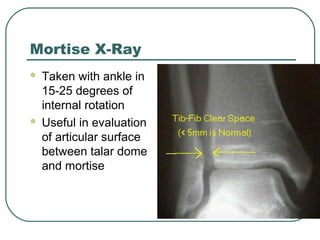 Mortise X-Ray 
 Taken with ankle in 
15-25 degrees of 
internal rotation 
 Useful in evaluation 
of articular surface 
between talar dome 
and mortise 
 