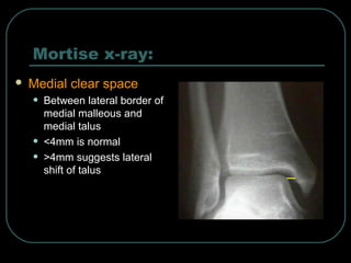 Mortise x-ray: 
 Medial clear space 
• Between lateral border of 
medial malleous and 
medial talus 
• <4mm is normal 
• >4mm suggests lateral 
shift of talus 
 