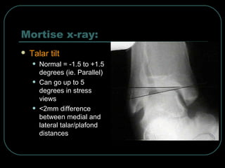 Mortise x-ray: 
 Talar tilt 
• Normal = -1.5 to +1.5 
degrees (ie. Parallel) 
• Can go up to 5 
degrees in stress 
views 
• <2mm difference 
between medial and 
lateral talar/plafond 
distances 
 