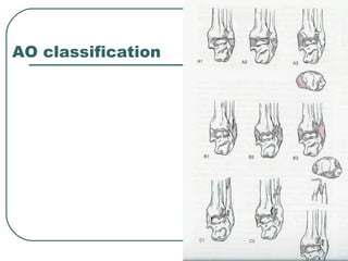 AO classification 
 
