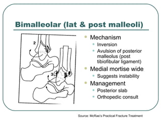 Bimalleolar (lat & post malleoli) 
 Mechanism 
• Inversion 
• Avulsion of posterior 
malleolus (post 
tibiofibular ligament) 
 Medial mortise wide 
• Suggests instability 
 Management 
• Posterior slab 
• Orthopedic consult 
Source: McRae’s Practical Fracture Treatment 
 