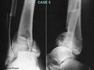 Sour ce:Rosen 
CASE 5 
 