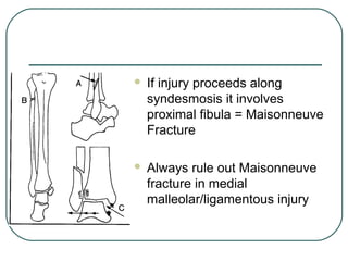  If injury proceeds along 
syndesmosis it involves 
proximal fibula = Maisonneuve 
Fracture 
 Always rule out Maisonneuve 
fracture in medial 
malleolar/ligamentous injury 
 