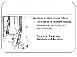  As talus continues to rotate 
• Posterior tib-fib ligament ruptures 
• Interosseous membrane rips 
• Gross diastasis 
• Dupuytren fracture – 
dislocation of the ankle 
 